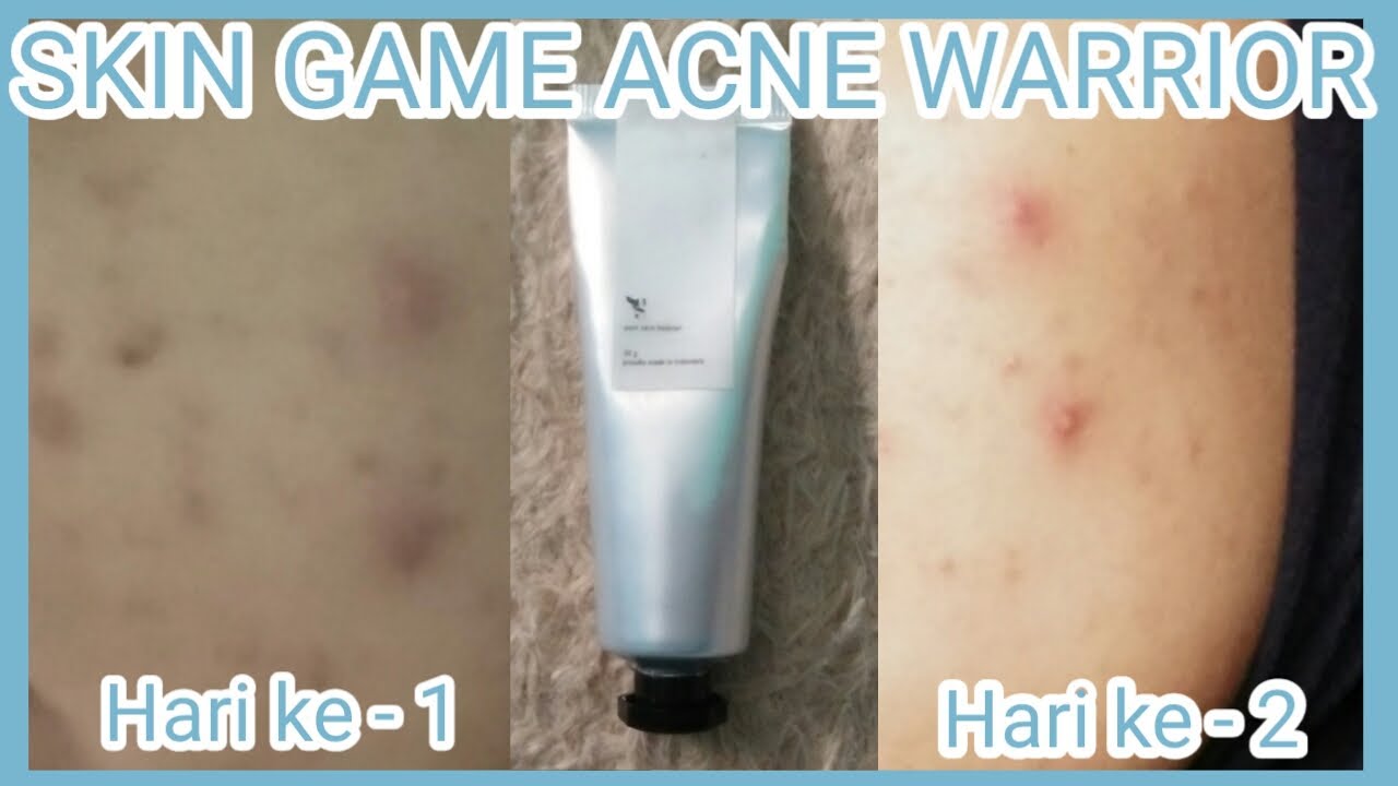 Review Skin Game Acne Warrior Update Terbaru